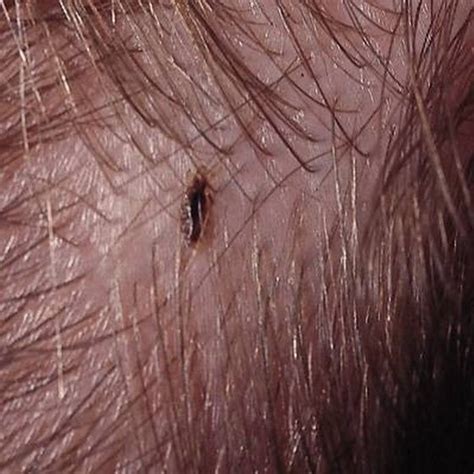 How To Get Head Lice Healthy Living