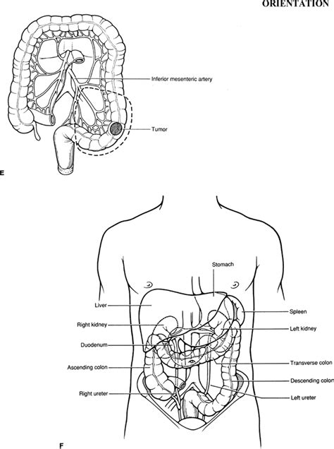 Right And Left Colon Resections Basicmedical Key