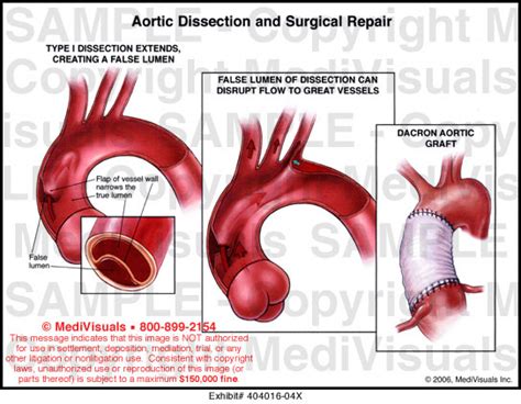 Aortic Dissection And Surgical Repair Medical Illustration Medivisuals