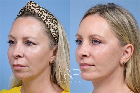 Facelift Before And After Pictures At Landp Aesthetics In Palo Alto Ca