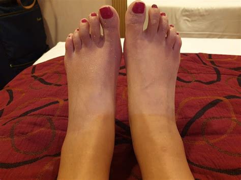 Top Tips To Prevent Swollen Ankles On Holiday Torbay Footcare