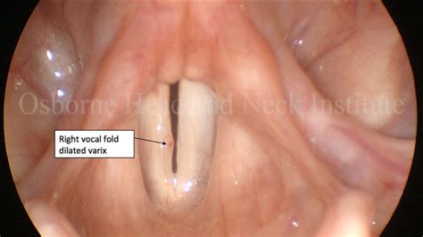 Voice Case Of The Week Vocal Hemorrhage