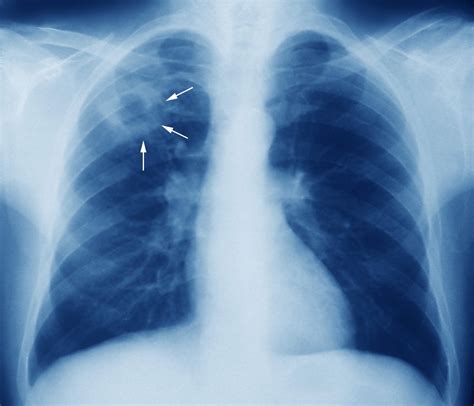 Tuberculosis Pulmonar Parte 1 Vida Abuelo Enfermedad Infecciosa