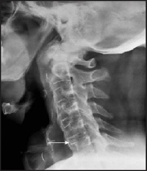 Radiograph Cervical Spine Lateral View Showing Straight Open I