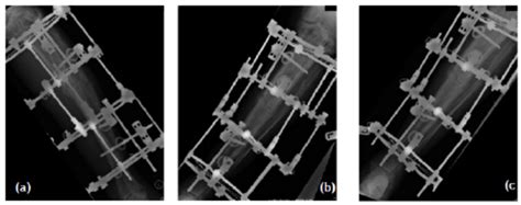 X Ray Images Following Surgical Fixation Of The Tibial Shaft Fracture