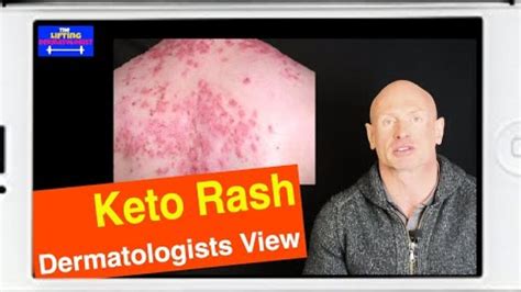 Keto Rash Ketogenic Rash Dermatologists View