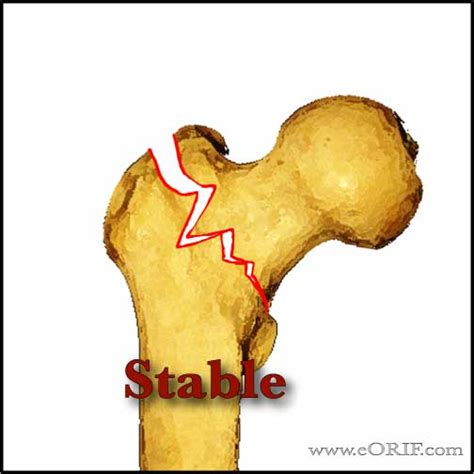 Intertrochanteric Femur Fracture Classification Eorif