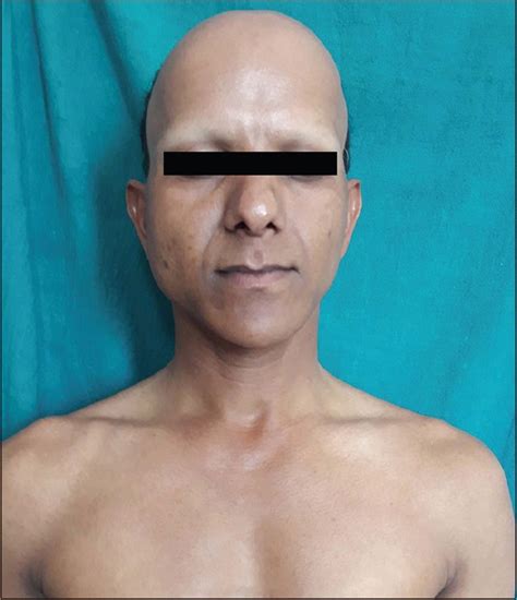 J eur acad dermatol venerol 2010; Kreisrunder Haarausfall (Alopecia areata) | Autoimmunportal.de