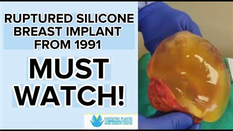 Ruptured Silicone Breast Implant From 1991 Must Watch Youtube