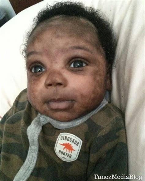 9 Weeks Old Baby Suffers From Skin Change Due To Wrong Baby Formula