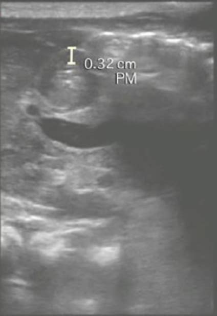 Brown Sound Point Of Care Ultrasound Diagnosis Of Pyloric Stenosis