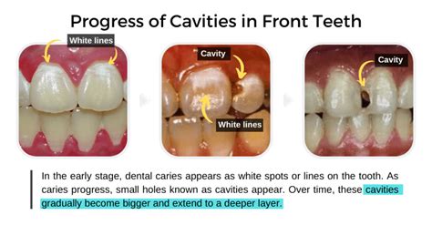 Cavities In Front Teeth Causes And Treatment Share Dental Care