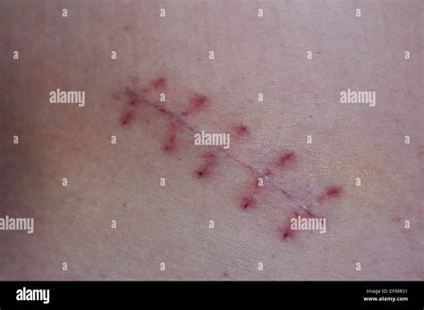 Scab Scar Hi Res Stock Photography And Images Alamy