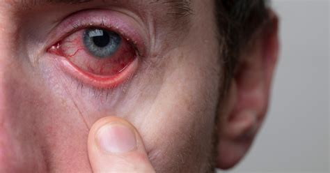 Is Pink Eye Contagious Understanding The Risks And Prevention