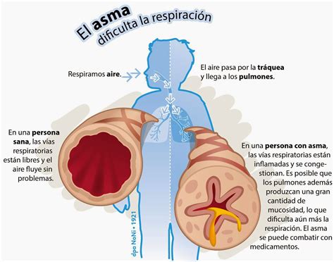 ENFERMERIA ASMA BRONQUIAL ASMA