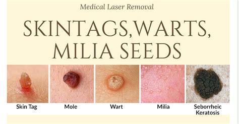 skin tags removal and how to rid them dr cindy s medical aesthetics