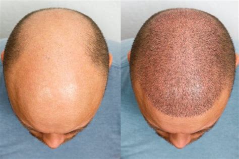 Comment se réalise un implant capillaire en Turquie ? - Santé L'expert