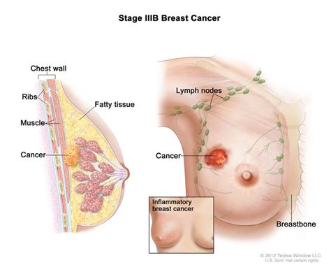 A cancer case will often find the fact that there is a hunk that may be distressing or painless in quality. Breast Cancer During Pregnancy (PDQ®)—Patient Version ...