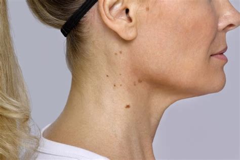 Do You Have A Bump On Your Neck This Is What It Could Mean Daily