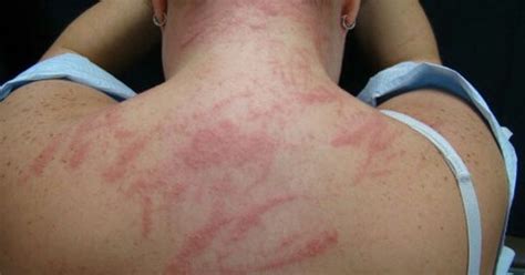 A rash is a change of the human skin which affects its color, appearance, or texture. Lupus Rash or an Autoimmune Rash - welts and hives that ...