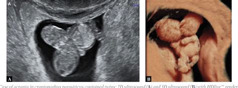 Figure 1 From Acrania Exencephaly Anencephaly Sequence Phenotypic Characterization Using Two