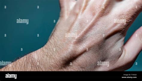 Close Up Shot Of A White Caucasian Man Left Hand With A Ganglion Cyst