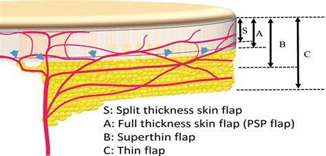 Pure Skin Perforator Flaps The Anatomical Vascularity Of Th