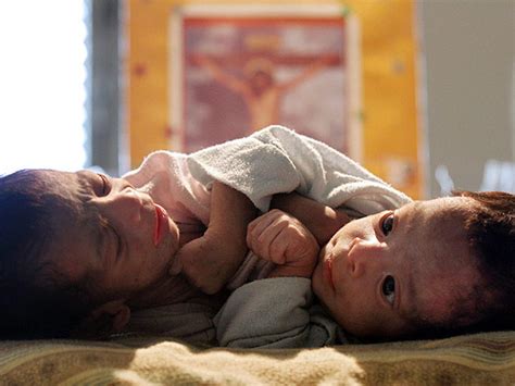Conjoined Twins Warning Graphic Images Cbs News