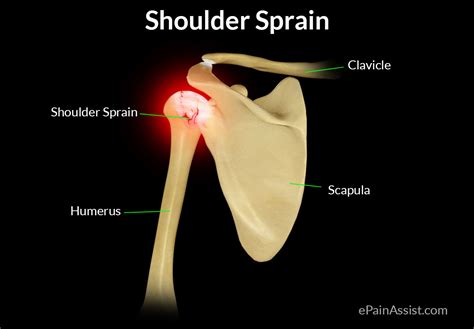 Shoulder Sprain Treatment Exercise Types Diagnosis