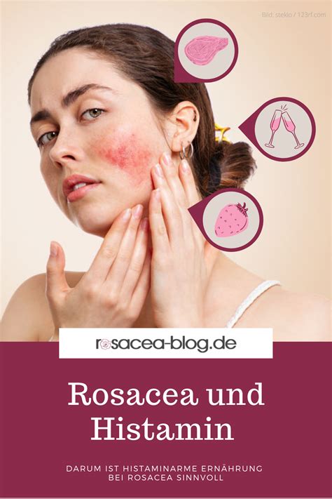 Darum Ist Histaminarme Ernährung Bei Rosacea Sinnvoll Rosacea Blog