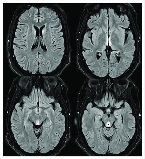 Mri Brain Flair Weighted Imaging Axial View Demonstrating Abnormal