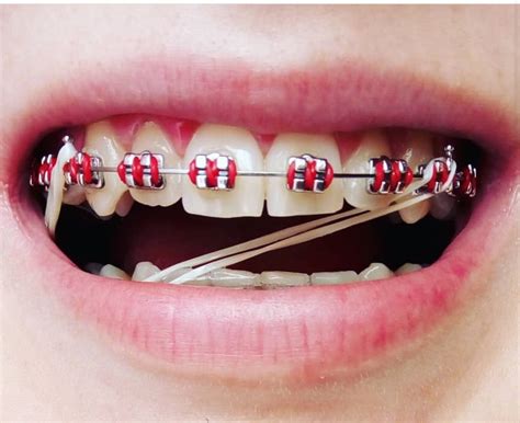 Pin De Sheri Nicolls Em Braces Aparelho Dental Aparelho Ortodontico Aparelho Ortodontico Cores