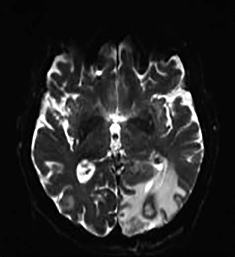 Mri Showing A Lesion In The Left Occipital Lobe Download Scientific