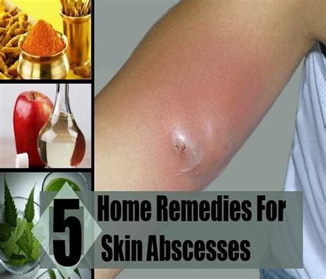 Boils And Abscesses Causes Symptoms Treatment Diagnosis And