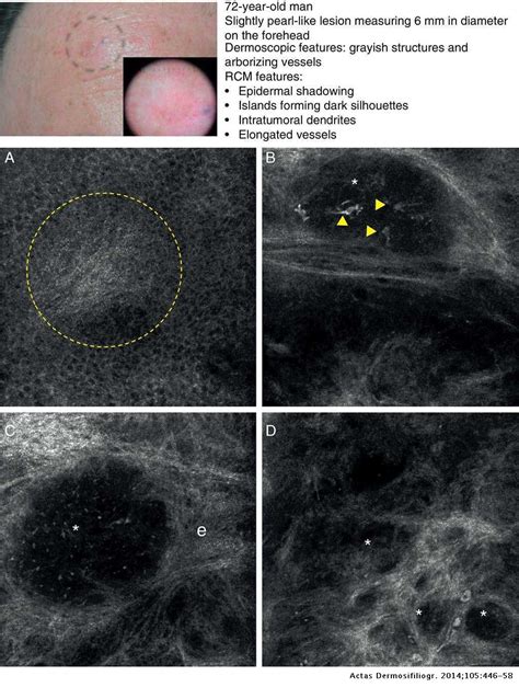 Confocal Microscopy Patterns In Nonmelanoma Skin Cancer And Clinical