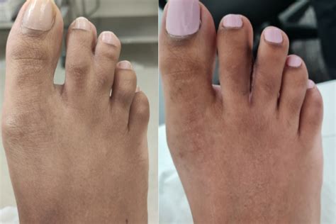 Webbed Toes Syndactyly Foot Podiatry Surgery