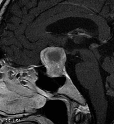 Pituitary Macroadenoma Null Cell Image