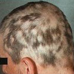 Men may experience hair loss in their facial hair, as well as their scalp, chest, and back hair. Patchy Hair Loss | Services - Hair Loss Treatment