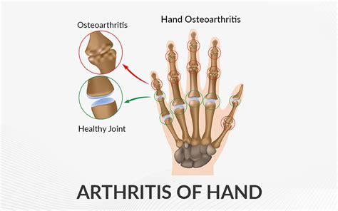 Osteoarthritis Hands