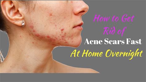 How To Get Rid Of Acne Scars Fast At Home Overnight Youtube