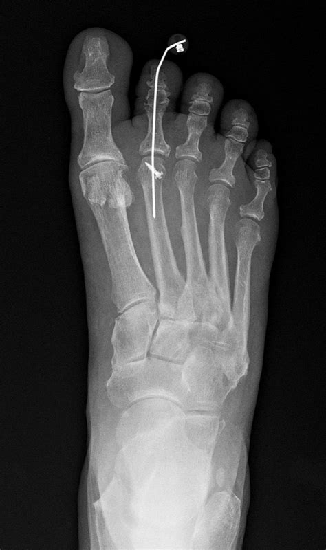 Hammer Toes Specialist Mansfield Tx Matthew Mccabe Dpm Ms Podiatrist Water Oak Foot And