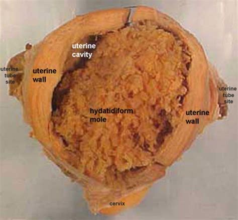 File Hydatidiform Mole Embryology