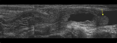 Scrotal Hernia Ultrasound