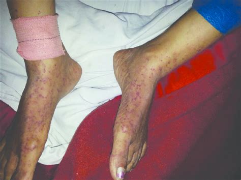 Vasculitic Rash Over Both The Legs Download Scientific Diagram