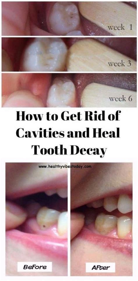 If you have a sharp pain or increased sensitivity in your tooth, you might have a cavity. HOW TO GET RID OF CAVITIES AND HEAL TOOTH DECAY #CAVITIES ...