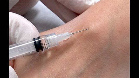 How To Drain A Cyst With A Needle Gegu Mall Reverasite