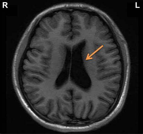 Magnetic Resonance Imaging Showing An Enlarged Left Lateral Ventricle