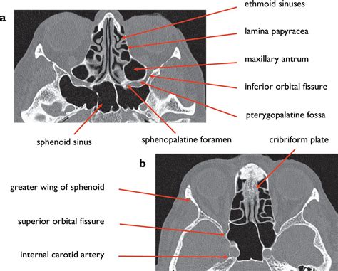 Normal Anatomy Of The Base Of The Skull Orbit Pituitary And Cranial