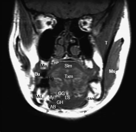 Floor Of Mouth Anatomy Mri