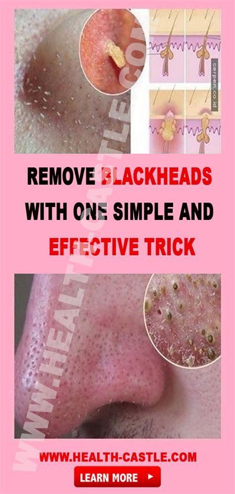 Remove Blackheads With One Simple And Effective Trick Remove Blackheads